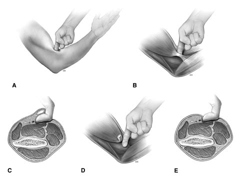 test for biceps tear|positive hook test.